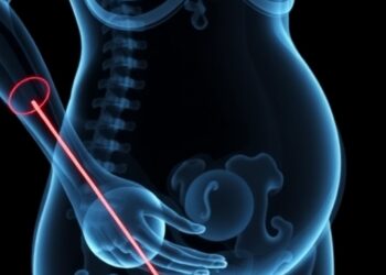AI Radiographic Analysis Links Heparin in Pregnancy to Reduced Maternal Bone Density