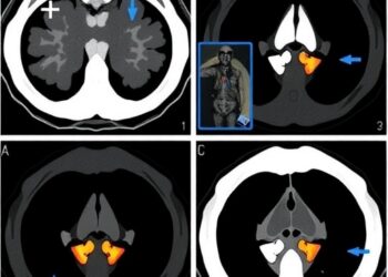 Automated Baseline FDG PET/CT Deauville Scoring Predicts Progression-Free Survival in Multiple Myeloma