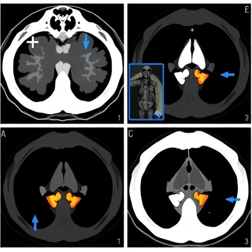 Automated Baseline FDG PET/CT Deauville Scoring Predicts Progression-Free Survival in Multiple Myeloma
