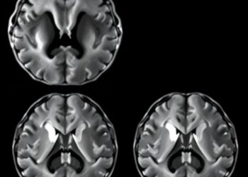 Baseline clinical features outperform MRI in predicting rapid cognitive-motor decline in Parkinson’s