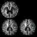 Baseline clinical features outperform MRI in predicting rapid cognitive-motor decline in Parkinson’s