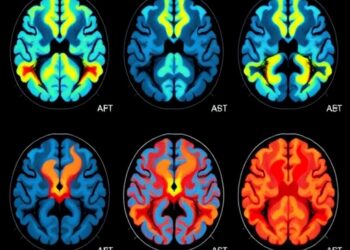 Brain scans detect tau accumulation in late-onset psychosis