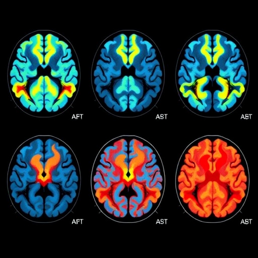 Brain scans detect tau accumulation in late-onset psychosis