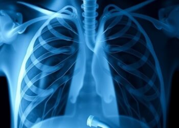 Bronchopulmonary Dysplasia Linked to Invasive Ventilation and Greater Respiratory Support