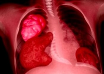 Chronic Expanding Hematoma Triggers Life-Threatening Hemoptysis and Respiratory Arrest: Case Report