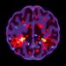 Covalent PFKL activator suppresses tumor growth