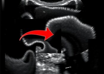 Deep Learning Precisely Grades Schistosoma japonicum Liver Fibrosis Using Ultrasound Images