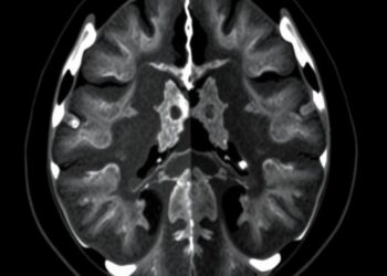 Deep learning sharpens CT detection of chronic sinus disease progression