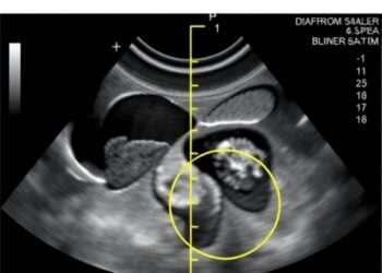 Diaphragm Ultrasound Reveals Differences in Lung Aeration Between Smaller and Typical Newborns