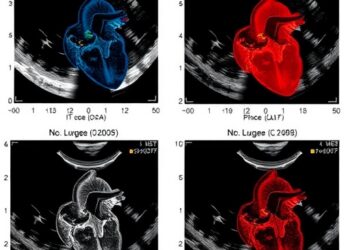 Early NT-proBNP Versus Echocardiographic PLASE Score for Predicting PDA Surgery