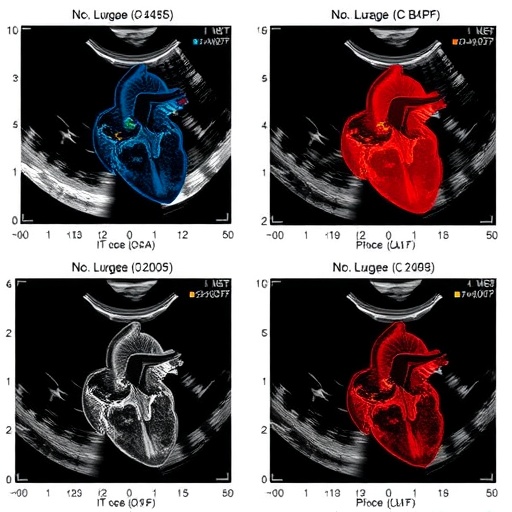 Early NT-proBNP Versus Echocardiographic PLASE Score for Predicting PDA Surgery