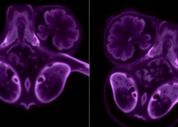 EVERGREEN Study Evaluates Everolimus After Progression in Advanced ER-Positive, HER2-Negative Breast Cancer