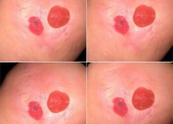 Explainable Skin Lesion Classification Uses Lightweight Multiscale Fusion, Convolutional Transformers, and SegmentAware-TreeSHAP