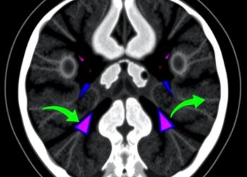 FAPI-04 PET/CT outperforms FDG in detecting recurrent breast cancer after surgery