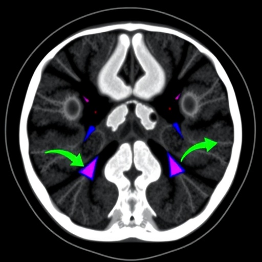 FAPI-04 PET/CT outperforms FDG in detecting recurrent breast cancer after surgery