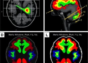 Fetal brain models show IL-17A disrupts cortical development after maternal immune activation