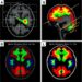 Fetal brain models show IL-17A disrupts cortical development after maternal immune activation