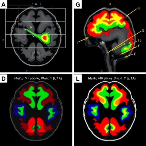 Fetal brain models show IL-17A disrupts cortical development after maternal immune activation