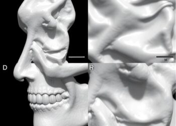GDLS-D Reconstructs Medical Surfaces in Two Stages Using Diffusion and Iterative Optimization