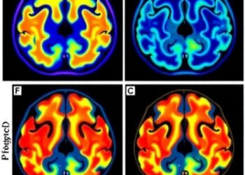 Genetic Factors Shape [18F]FDG PET Metabolic Patterns in Lewy Body Dementia