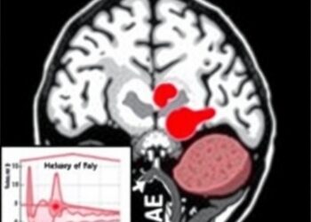 German Survey Examines Induced Hypertension for Delayed Ischemia After Aneurysmal Subarachnoid Hemorrhage