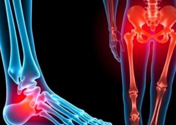 GLP-1 drugs tied to fewer fractures in adults with type 2 diabetes