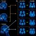 Harmonized PRx Protocol for Adult and Pediatric TBI with ICP Monitoring