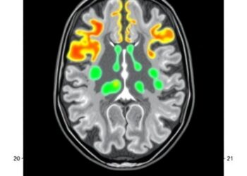 High-Contrast [¹⁸F]SiTATE PET/CT Imaging Maps Somatostatin Receptors in Meningiomas