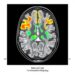 High-Contrast [¹⁸F]SiTATE PET/CT Imaging Maps Somatostatin Receptors in Meningiomas