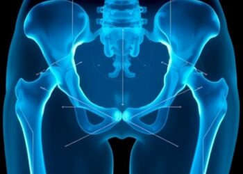 Hip X-ray indices may improve osteoporosis screening before hip replacement in women