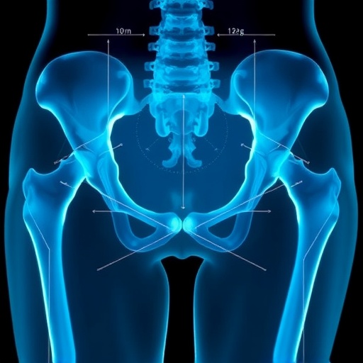 Hip X-ray indices may improve osteoporosis screening before hip replacement in women