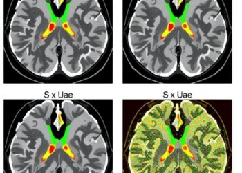 HisToSpatialCNV Predicts Spatial Copy-Number Variations from Pathology Images Using Interpretable Deep Learning