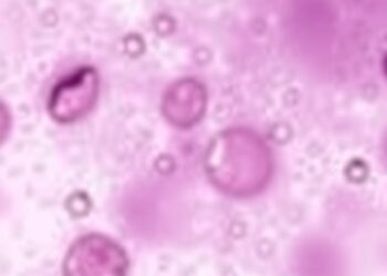 Hyaluronic Acid May Predict Severity of Down Syndrome-Associated Transient Abnormal Myelopoiesis