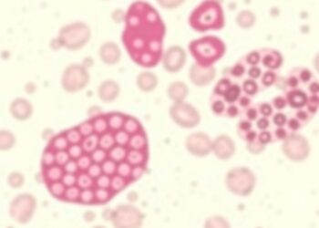 Indolent γδ Double-Negative T-Large Granular Lymphocytic Leukemia Linked to STAT5B T628S Mutation
