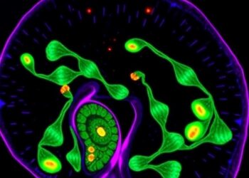 KRAS and SKIL Mutations Jointly Drive Pancreatic Cancer by Degrading Smad4