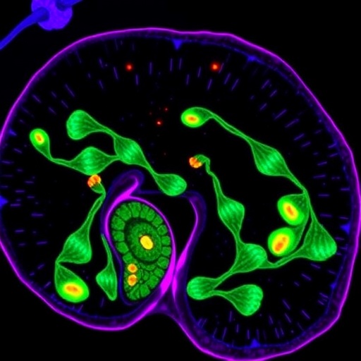 KRAS and SKIL Mutations Jointly Drive Pancreatic Cancer by Degrading Smad4