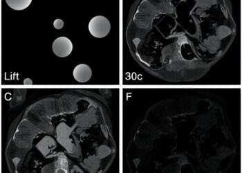 Lipid remodeling in serum and tumor margins tracks colorectal cancer progression