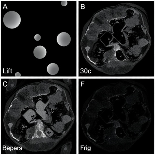 Lipid remodeling in serum and tumor margins tracks colorectal cancer progression