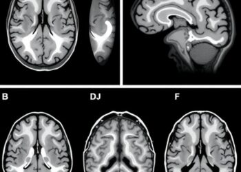 Mild Cognitive Impairment Shows Distinct Brain Atrophy Patterns With Clinical Implications