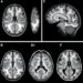 Mild Cognitive Impairment Shows Distinct Brain Atrophy Patterns With Clinical Implications