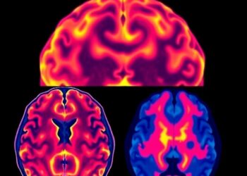 New Imaging Model May Improve Tracking of Brain Changes in Neurodegenerative Diseases