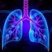 New predictors help stratify bronchiolitis obliterans risk after pediatric stem cell transplant