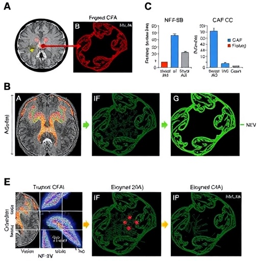 NF-κB-Active Tumors, Matrix CAFs, and Immunosuppression Drive Chemoradiation Resistance in Rectal Cancer