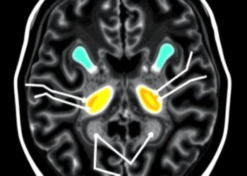 Obesity Shows Normal Dopamine Uptake on [18F]FDOPA PET Imaging