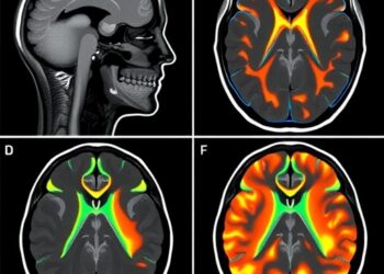 Perfusion Imaging Could Guide Treatment in Mild Large-Vessel Occlusion Stroke