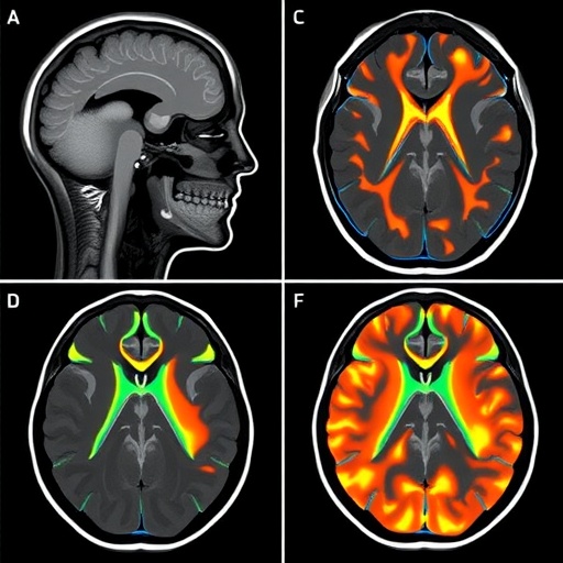 Perfusion Imaging Could Guide Treatment in Mild Large-Vessel Occlusion Stroke