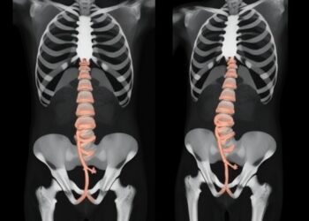 Posterior Transosseous S1 Pedicle Approach Reaches Superior Hypogastric Plexus