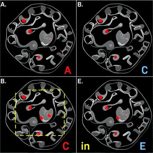 Preliminary CAR-T Consolidation With or Without ASCT in Relapsed/Refractory Large B-Cell Lymphoma