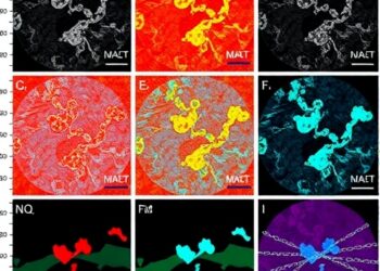 Proteomics maps spatial and molecular diversity in advanced carotid artery plaques