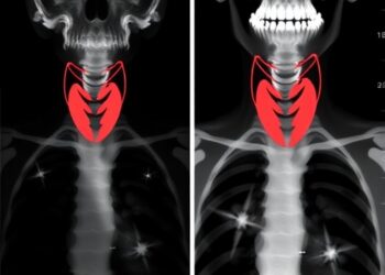 Randomized Trial Compares Lobectomy and Total Thyroidectomy for Indeterminate-Risk Thyroid Cancer